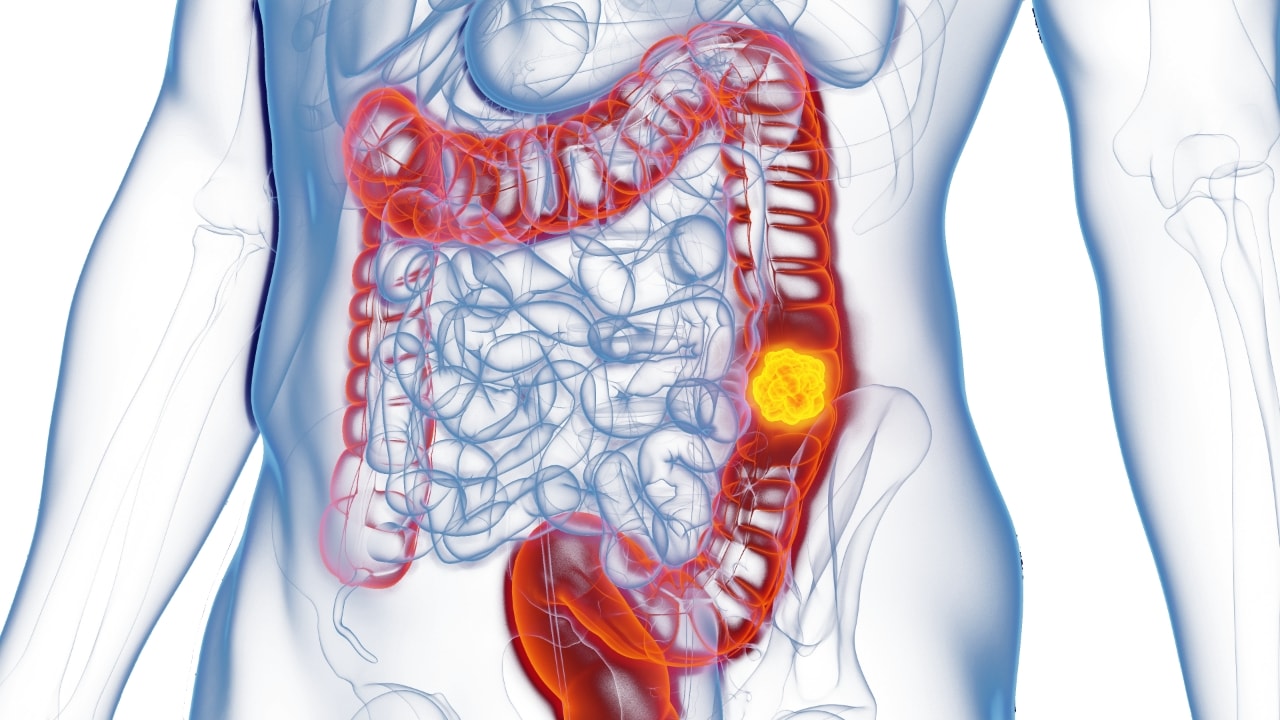 Schéma du colon chez un patient atteint de rectocolite hémorragique