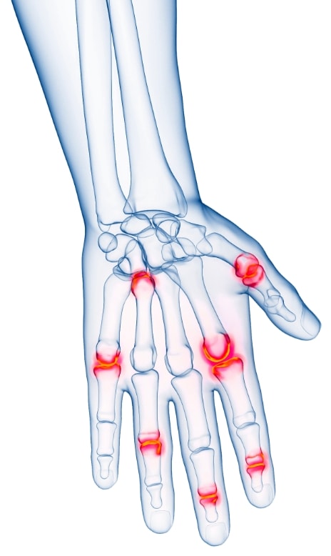 Localisation des atteintes articulaires du rhumatisme psoriasique