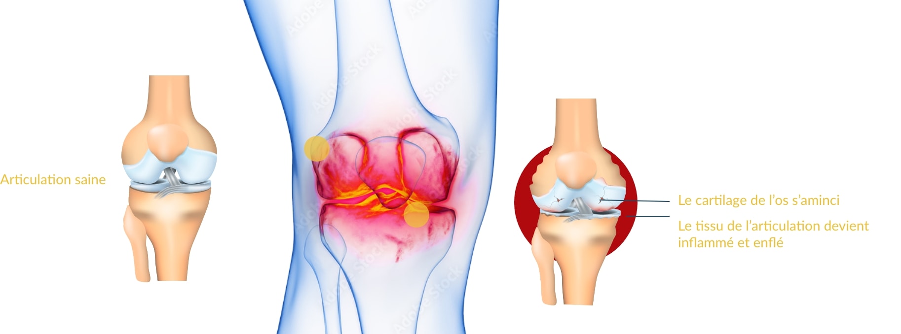 Schéma de la polyarthrite rhumatoïde au niveau du genou