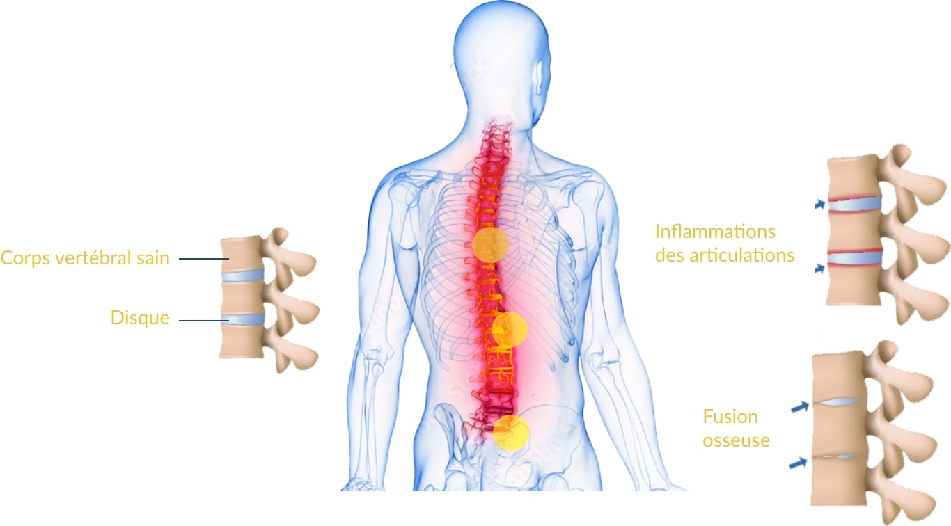 Comparaison d'une articulation malade à une articulation saine